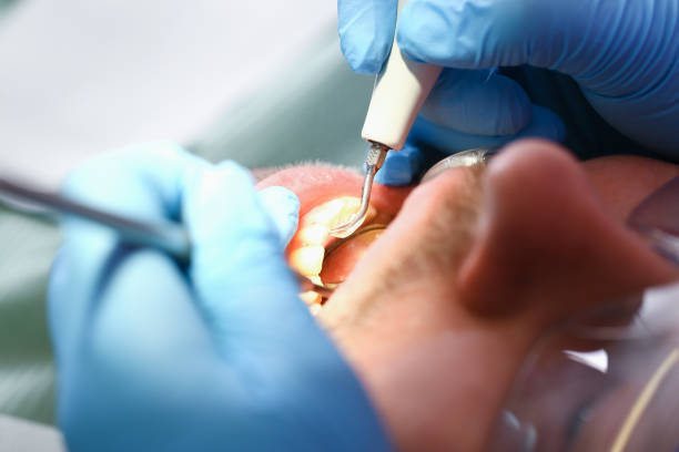 Best Knocked-Out Tooth (Avulsed Tooth) Treatment in Farngton Hills, MI